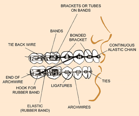 Braces Diagram